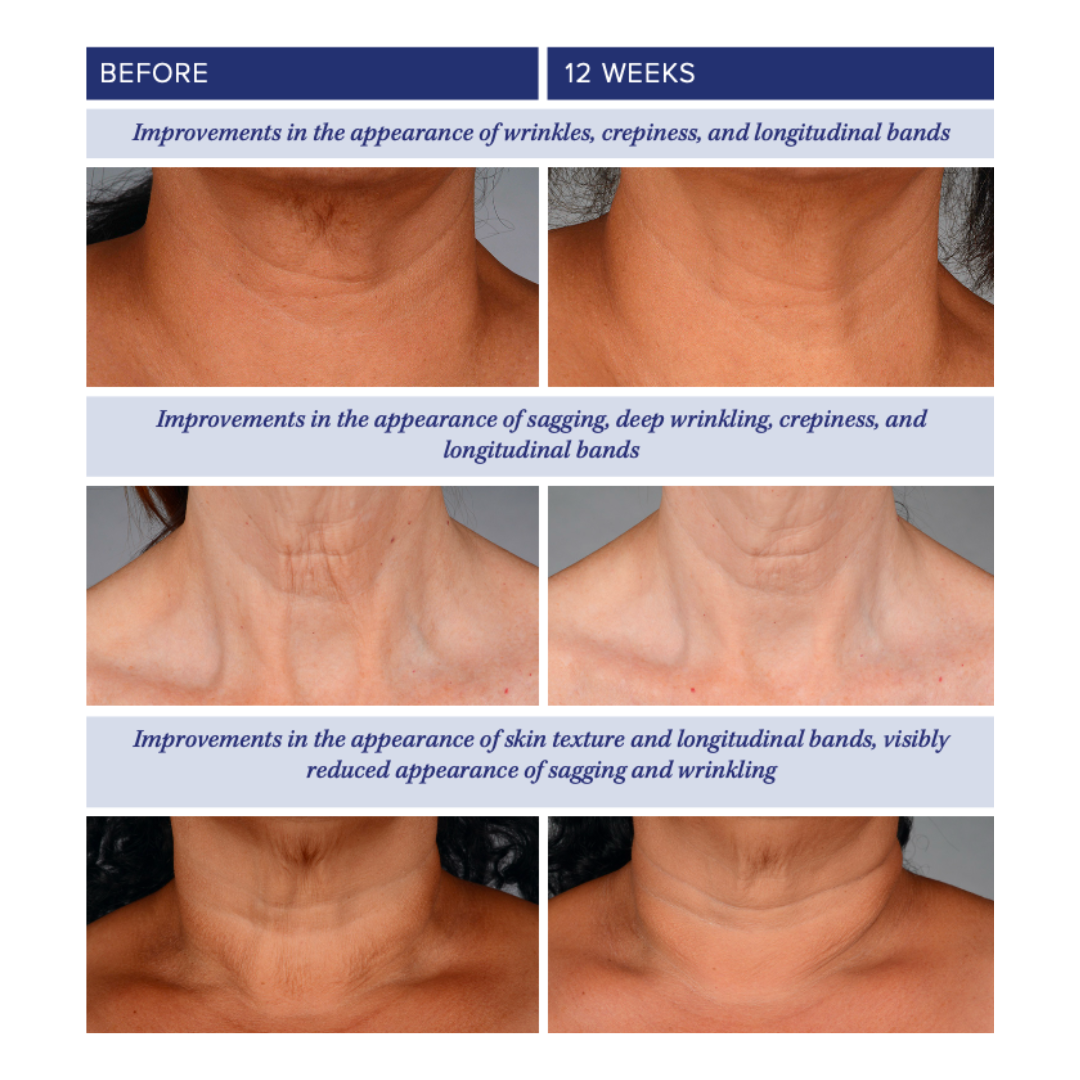 iS Clinical NeckPerfect Complex 50g